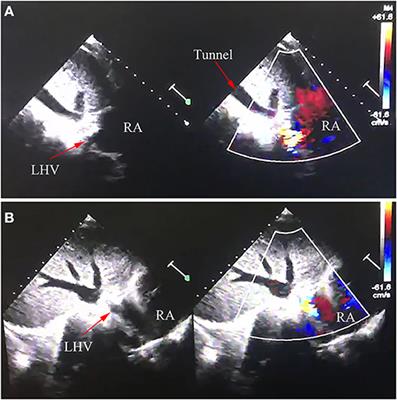 Case Report: An Anomalous Left Hepatic Venous Connection in a Patient With Unexpected Cyanosis